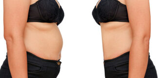 Co warto wiedzieć o zabiegu odsysania tłuszczu